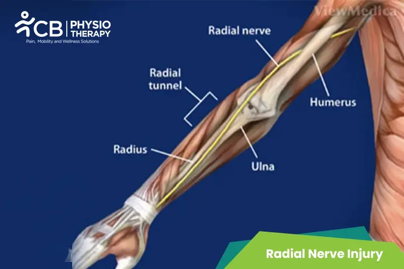 radial-nerve-injury.webp