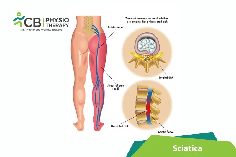 What Is Sciatica?, Symptoms ,Causes, Diagnosis & Physiotherapy Treatment Of  Sciatica
