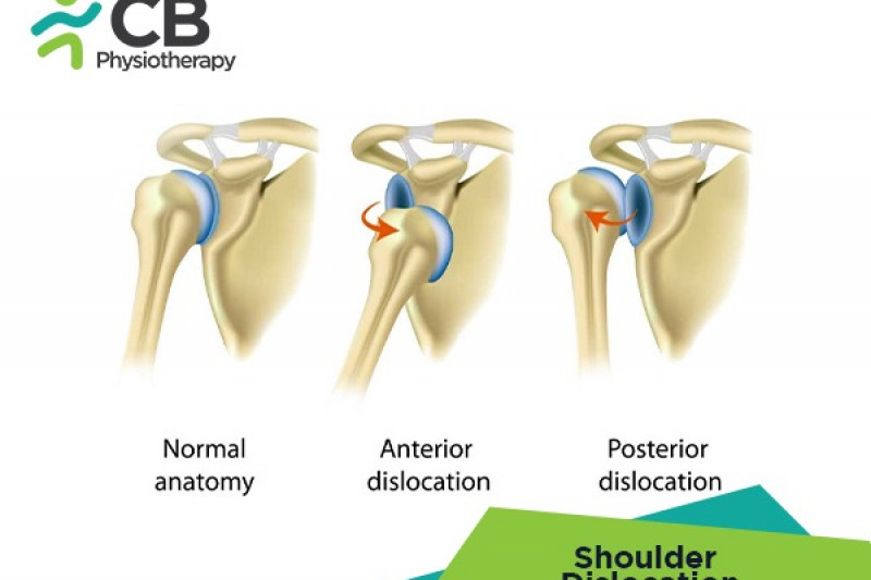 shoulder-dislocation.webp
