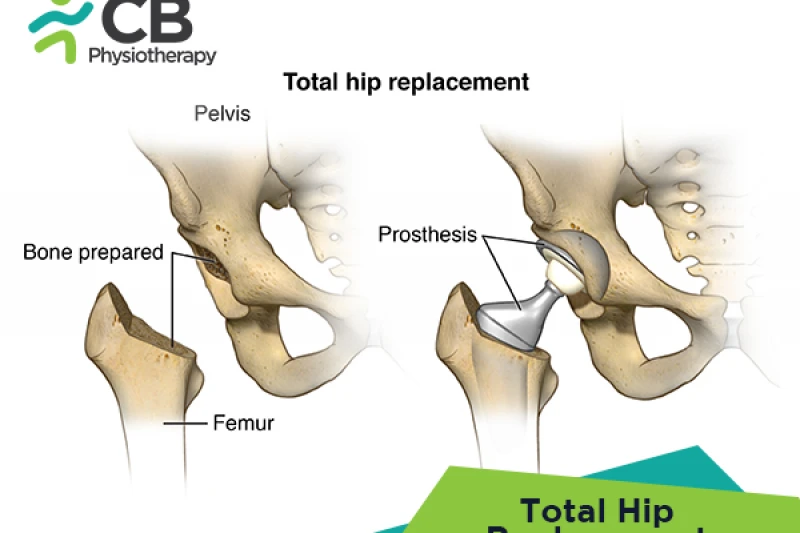 Total Hip Replacement (thr)