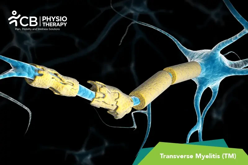 transverse-myelitis-tm.webp