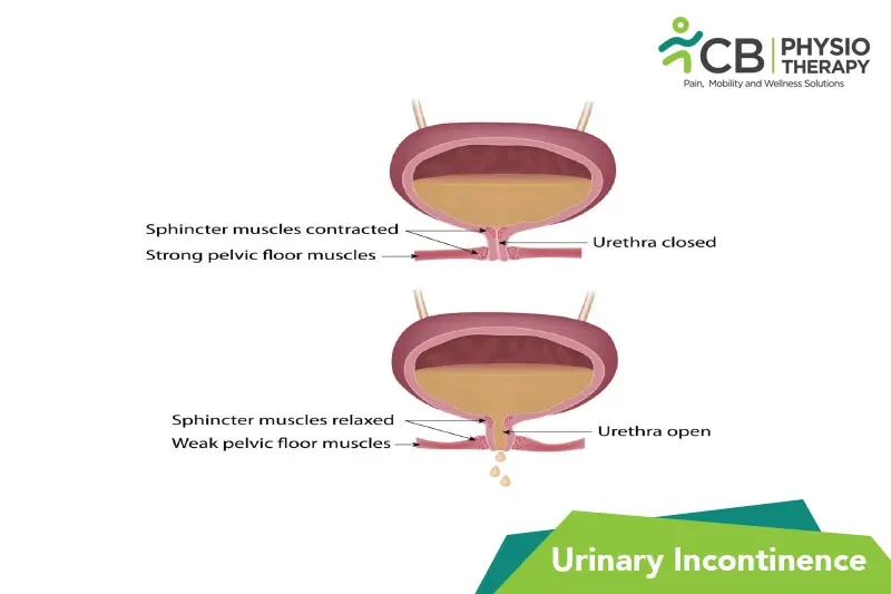 What Is Urinary Incontinence?, Symptoms, Causes, Diagnosis