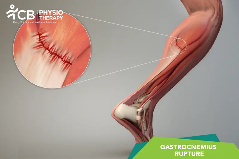 Gastrocnemius Rupture