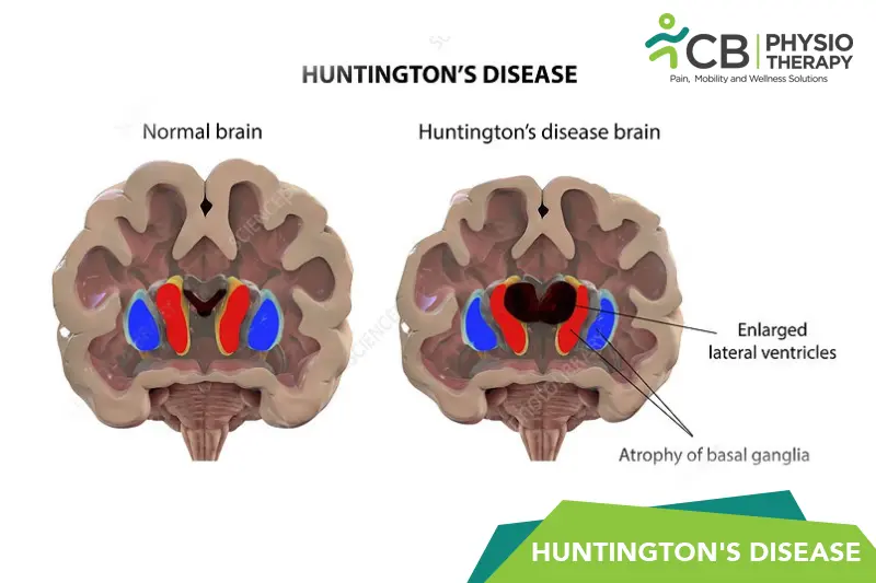 Huntington's Disease (hd)