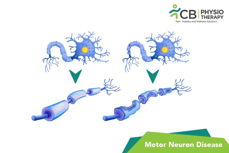 Motor Neuron Disease (mnd)