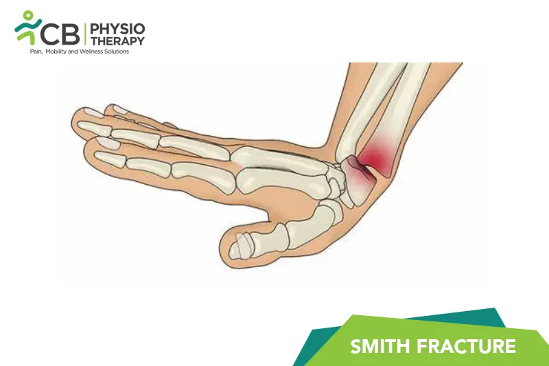 Smith Fracture