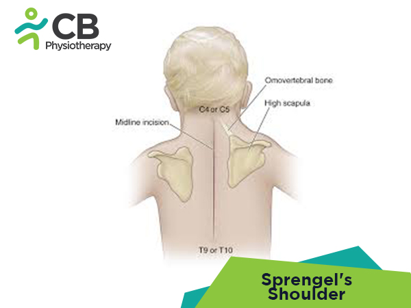 Sprengel's Shoulder
