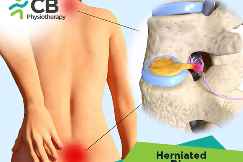 Top 5 Exercises For Herniated Disk Or Slipped Disc