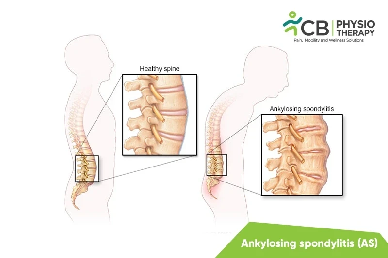 Top 5 Exercises For Ankylosing Spondylitis (as)