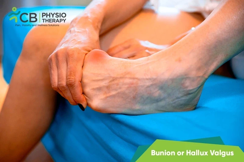 Top 5 Exercises For Bunion Or Hallux Valgus