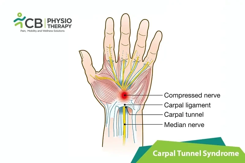 Top 5 Exercises For Carpal Tunnel Syndrome (cts)