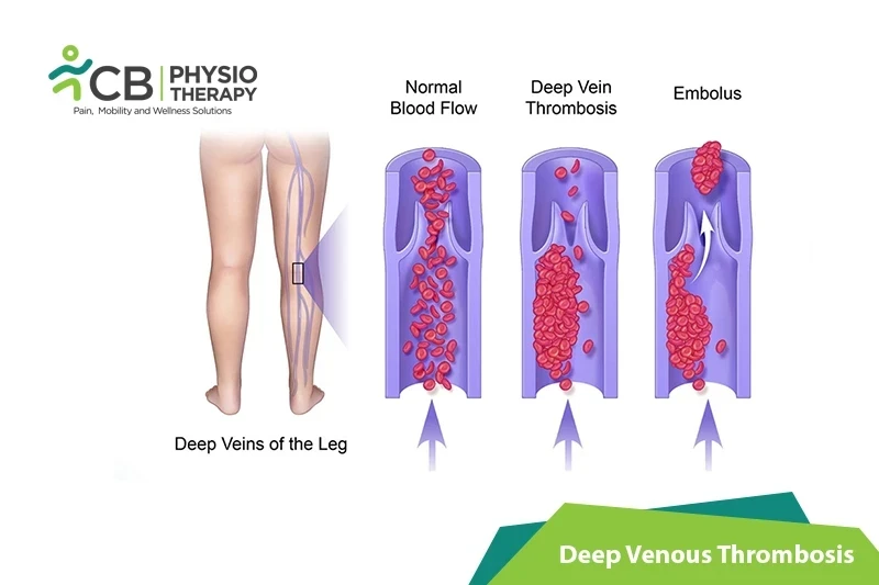 Top 5 Exercises For Deep Venous Thrombosis