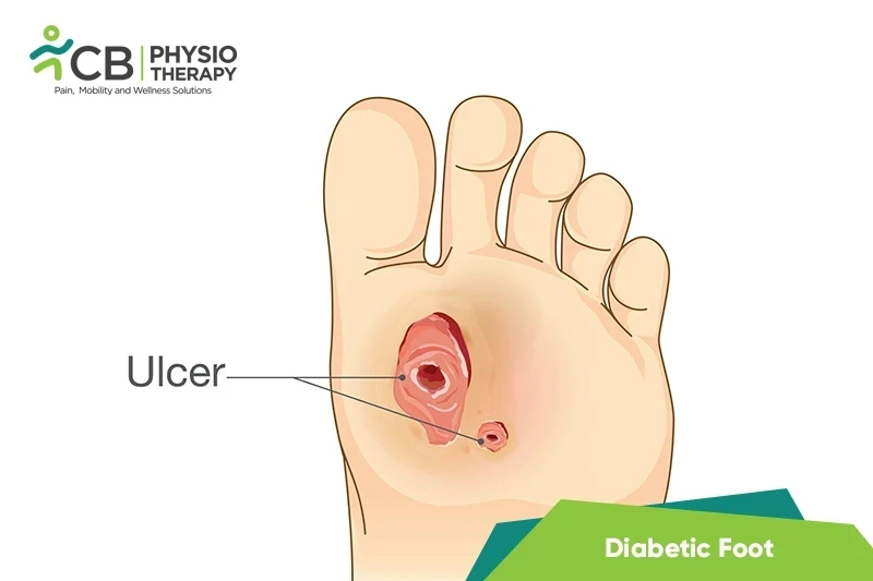 Top 5 Exercises For Diabetic Foot