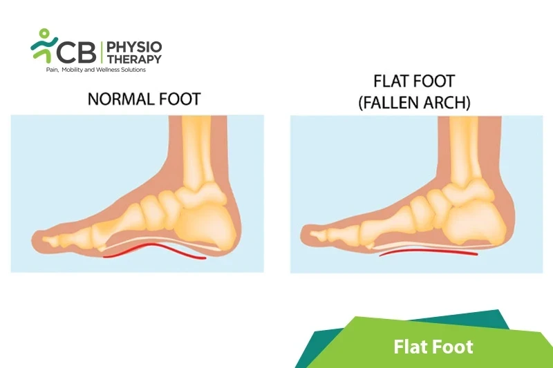 Top 5 Exercises For Flat Foot