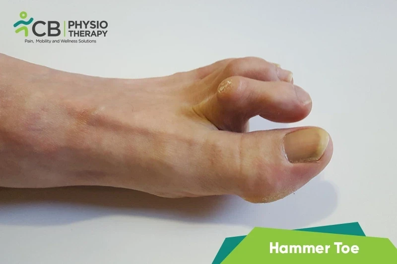 Top 5 Exercises For Hammer Toe