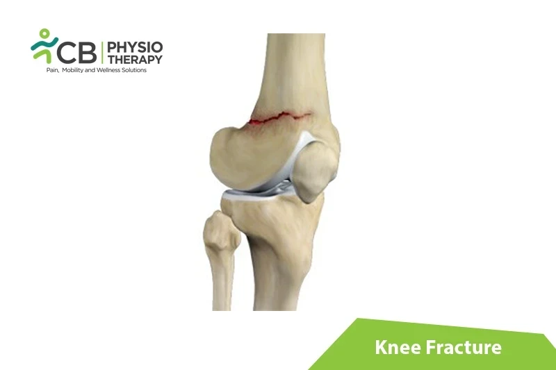 Top 5 Exercises For Knee Fracture