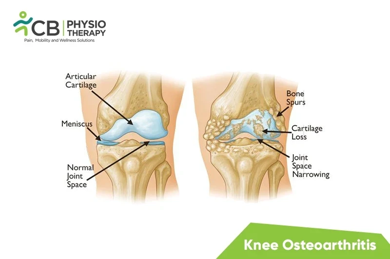 Top 5 Exercises For Knee Osteoarthritis