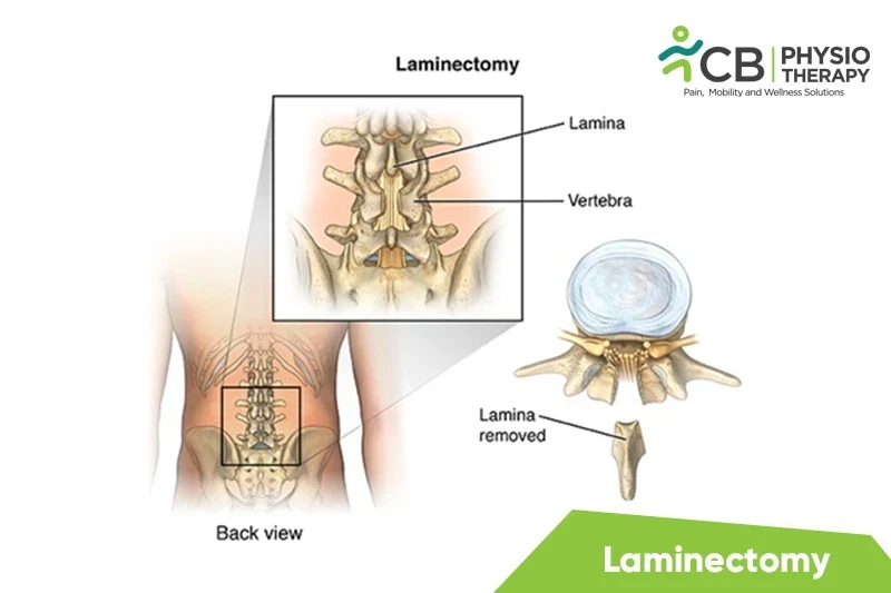 Top 5 Exercises For Laminectomy