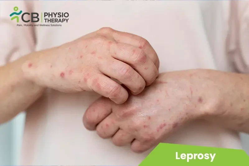 Top 5 Exercises For Leprosy