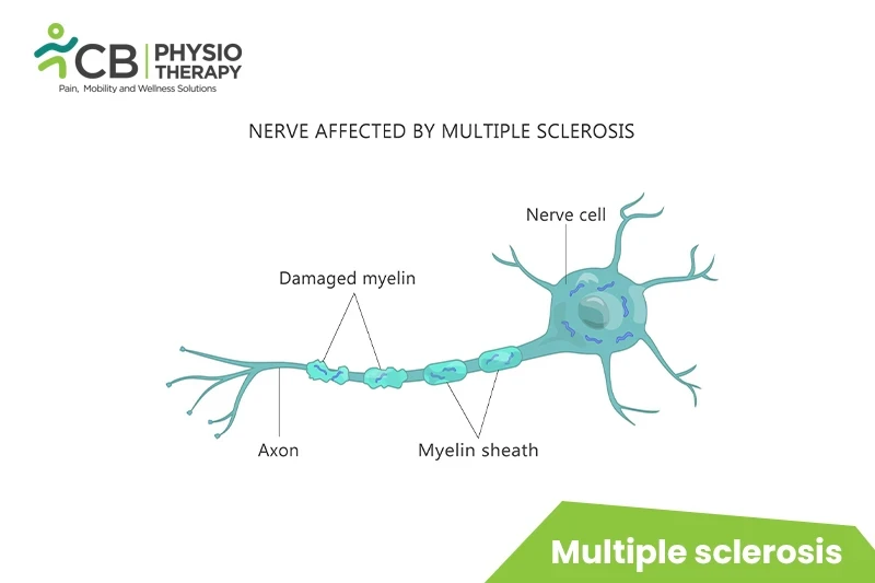 Top 5 Exercises For Multiple Sclerosis