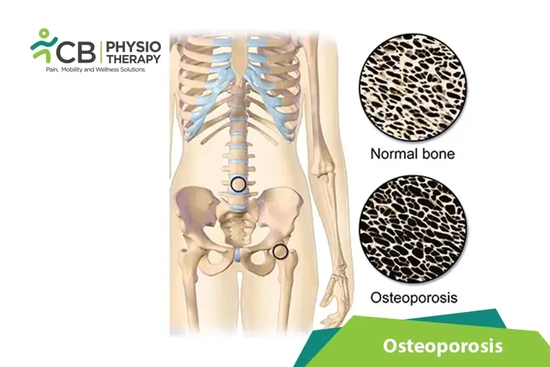Top 5 Exercises For Osteoporosis