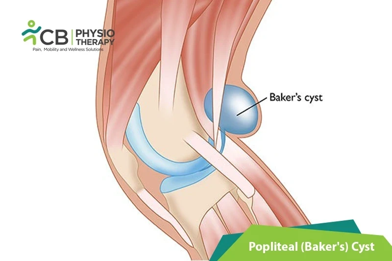 Top 5 Exercises For Popliteal Baker's Cyst