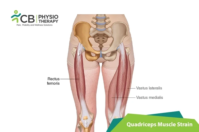 Top 5 Exercises For Quadriceps Muscle Strain