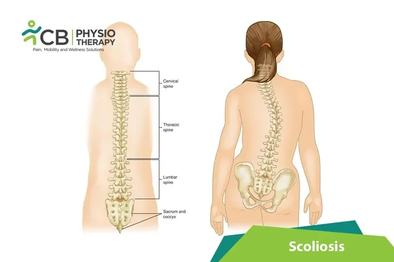 Top 5 Exercises For Scoliosis
