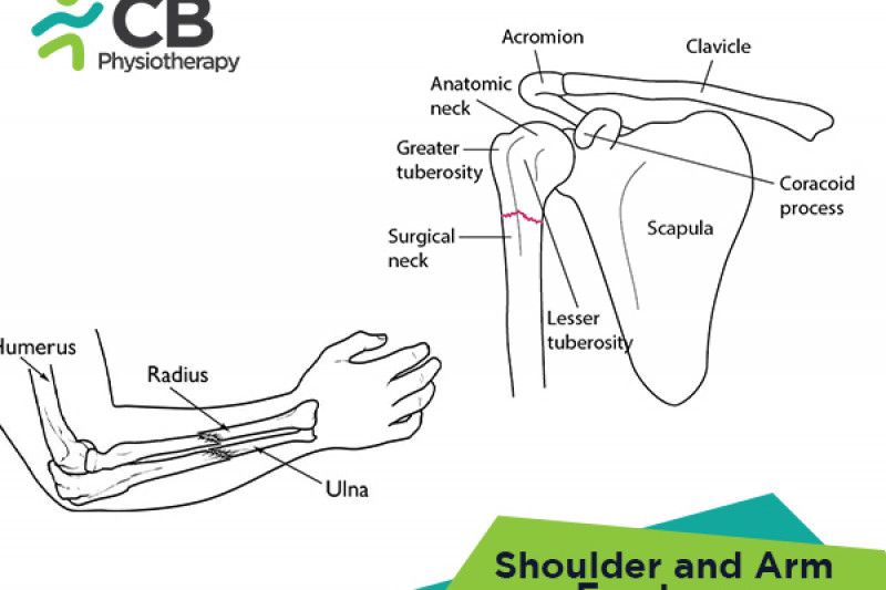 Top 5 Exercises For Shoulder And Arm Fractures