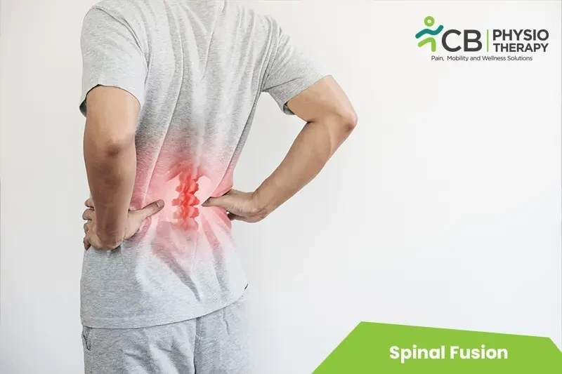 Top 5 Exercises For Spinal Fusion