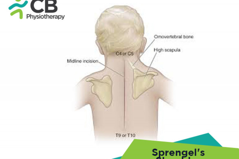 Top 5 Exercises For Sprengel's Shoulder