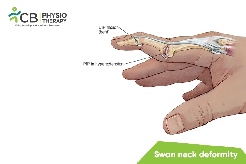 Top 5 Exercises For Swan Neck Deformity