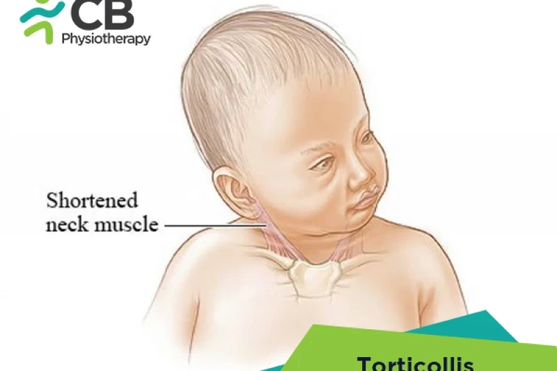 Top 5 Exercises For Torticollis