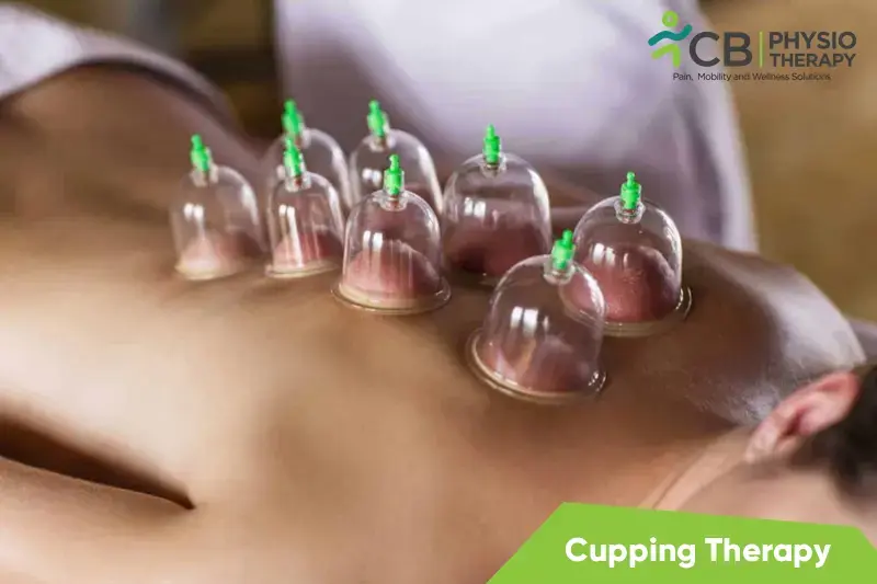 Cupping Therapy