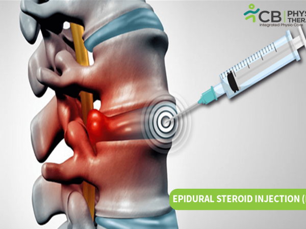 Disc Space Injection What Is An Epidural Injection For Bulging Disc