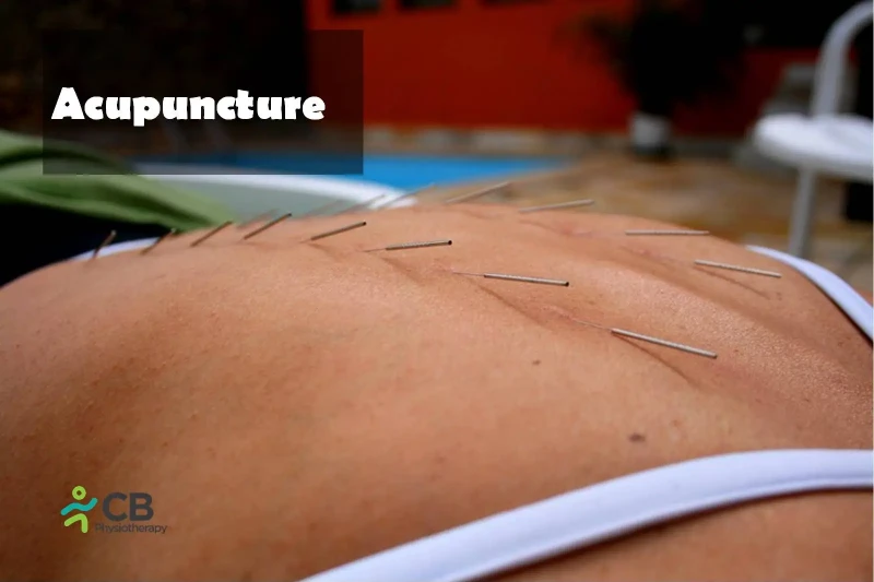 acupuncture.webp