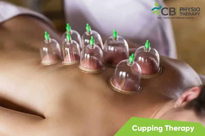 cupping-therapy.webp