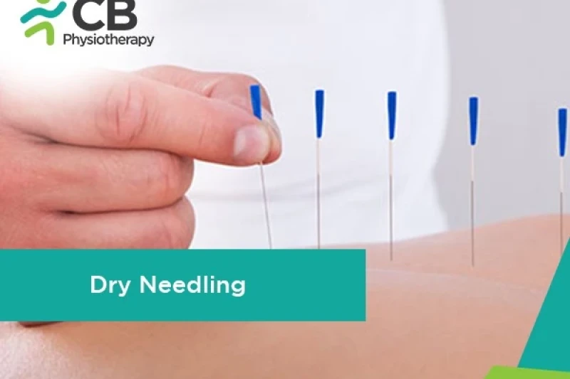 dry-needling-therapy.webp